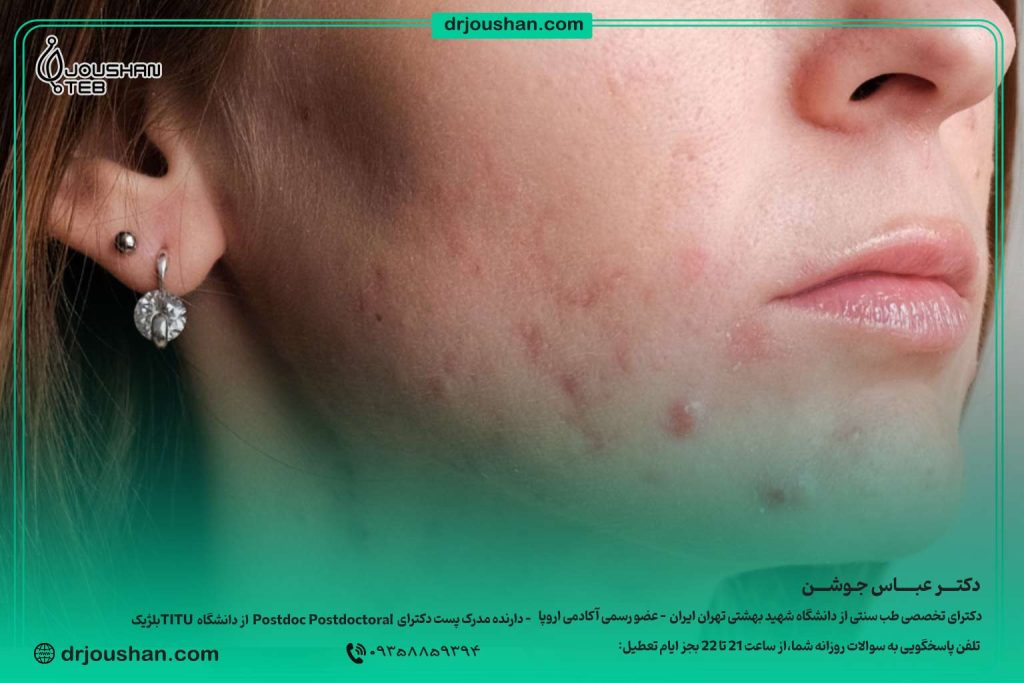 آکنه-بزرگسالان-در-خانم‌-ها
