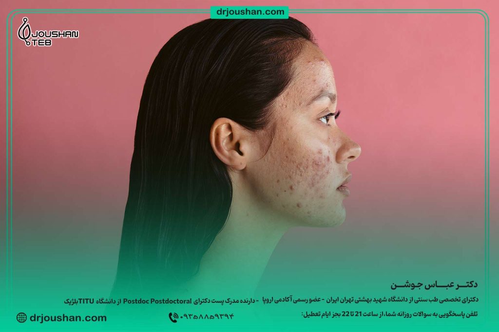 آکنه-بزرگسالان-در-خانم‌ها