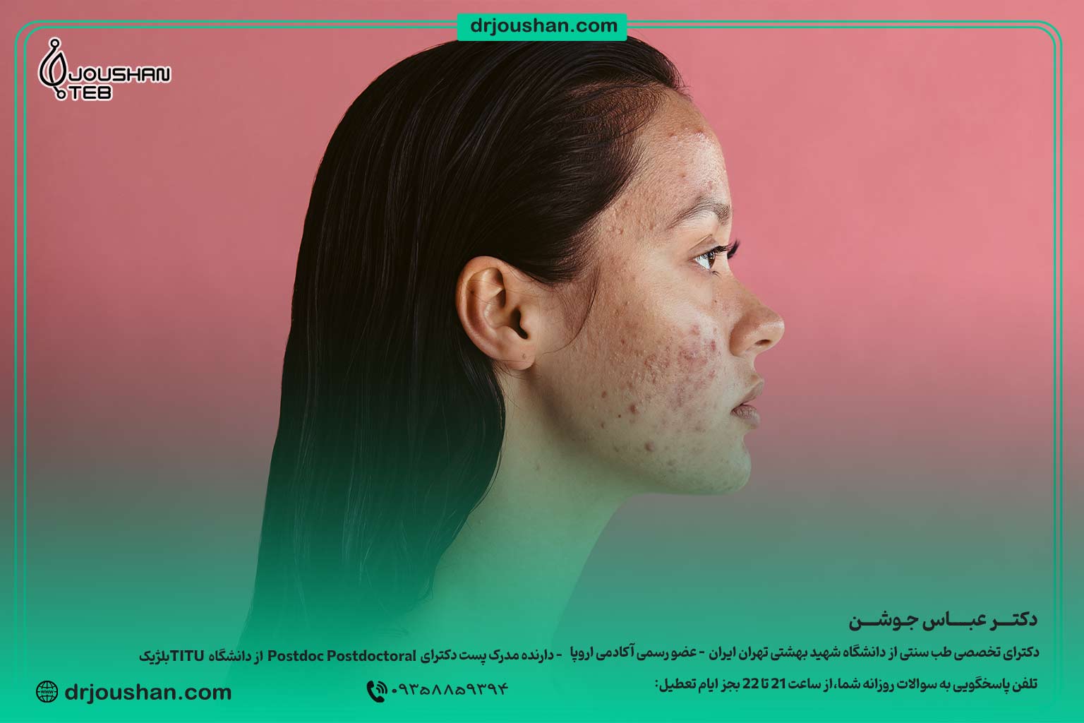 آکنه-بزرگسالان-در-خانم‌ها