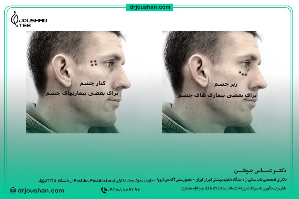 زالو گذاری در کنار چشم برای بیماری های چشمی
