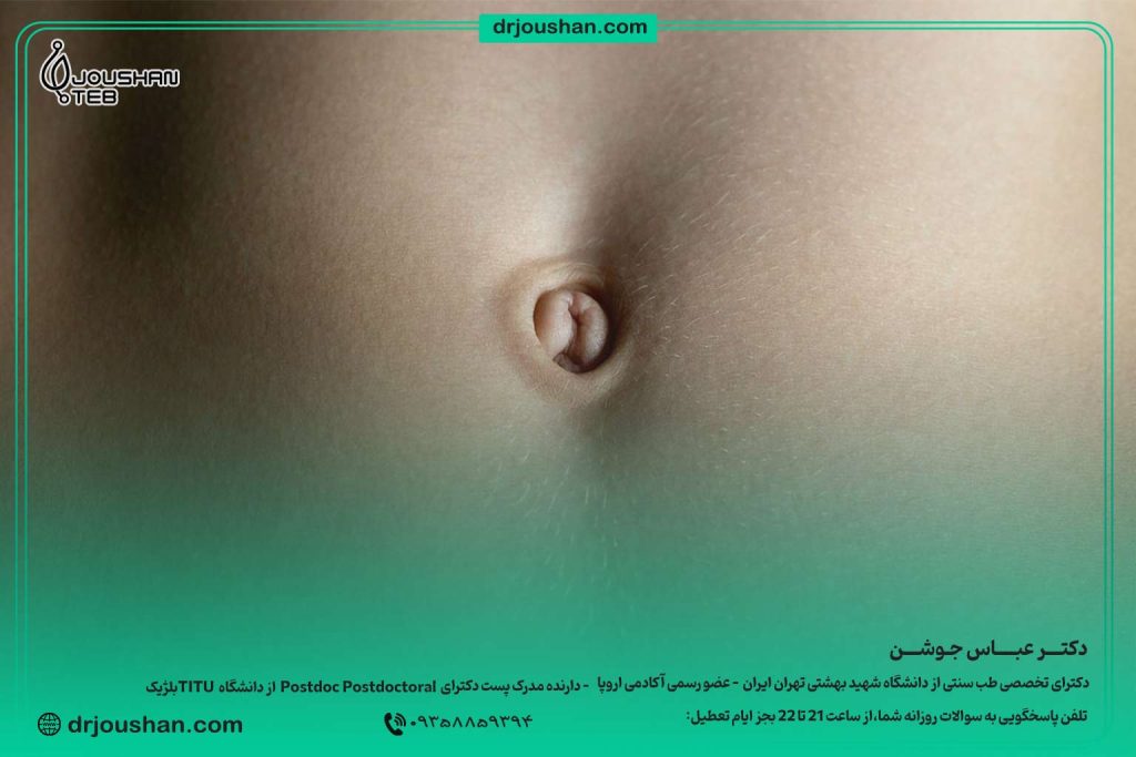 «جا-افتادن-ناف»،-«افتادگی-ناف»-یا-«جابجایی-ناف