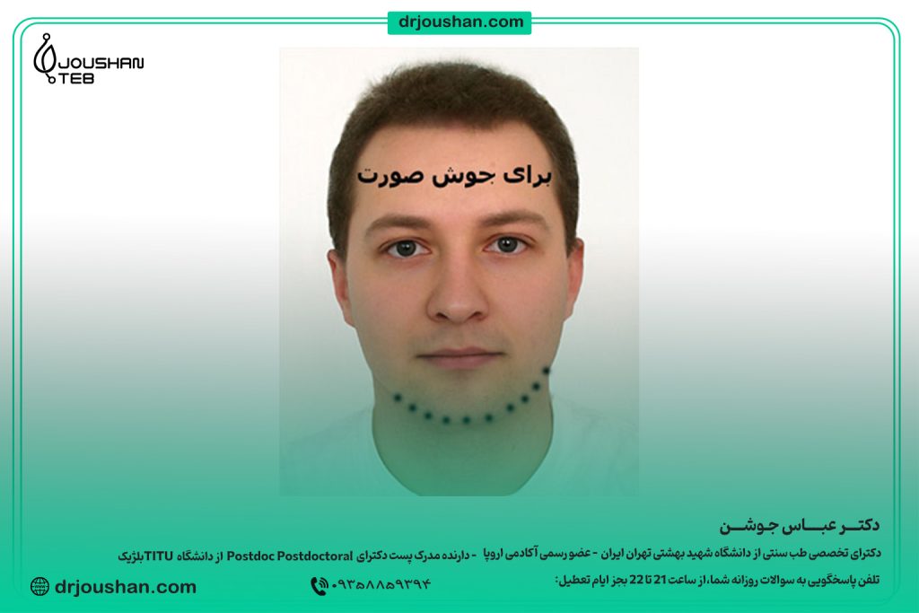 زالو گذاری برای جوش صورت