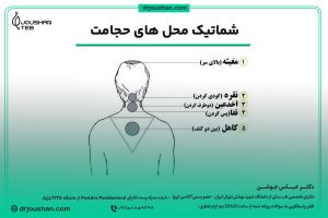 محل های دقیق حجامت سر