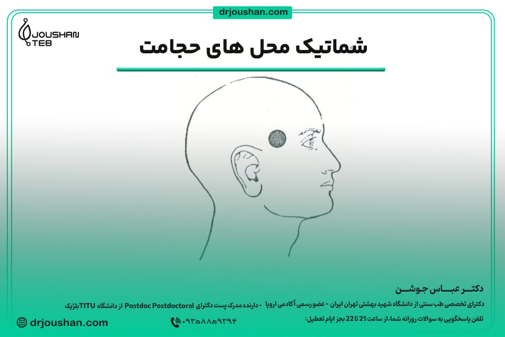 محل حجامت شقیقه‌ها
