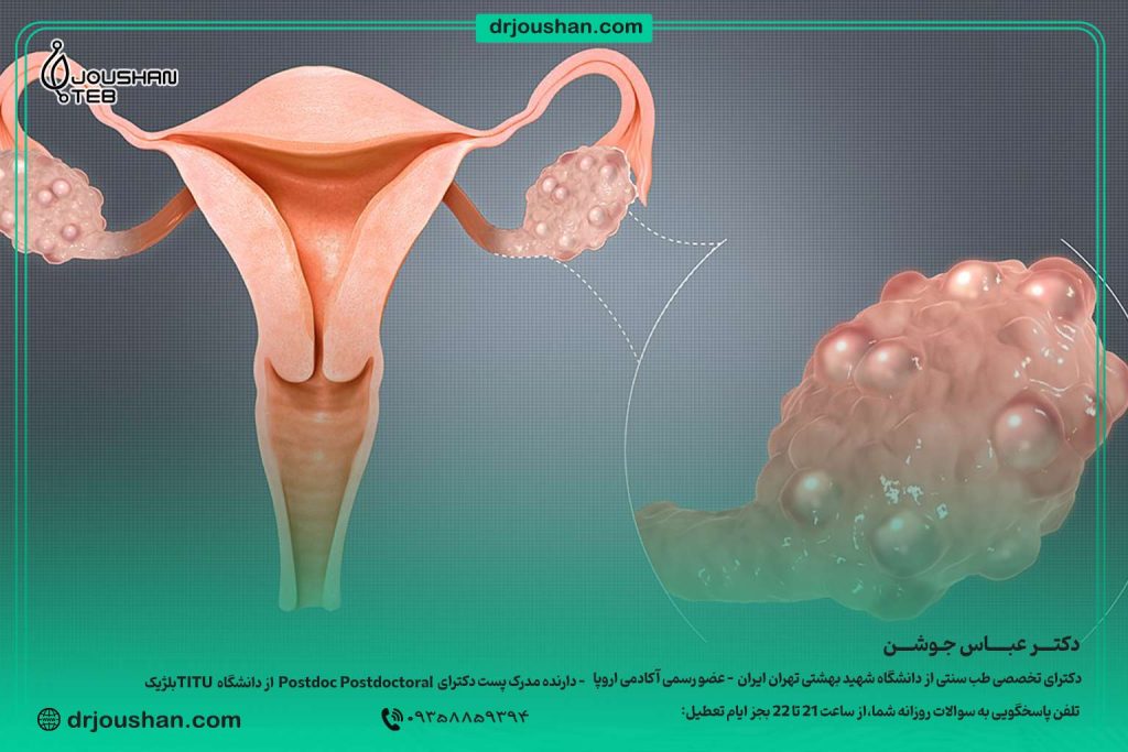 درمان-تخمدان-پلی‌کیستیک-با-تنظیم-خواب