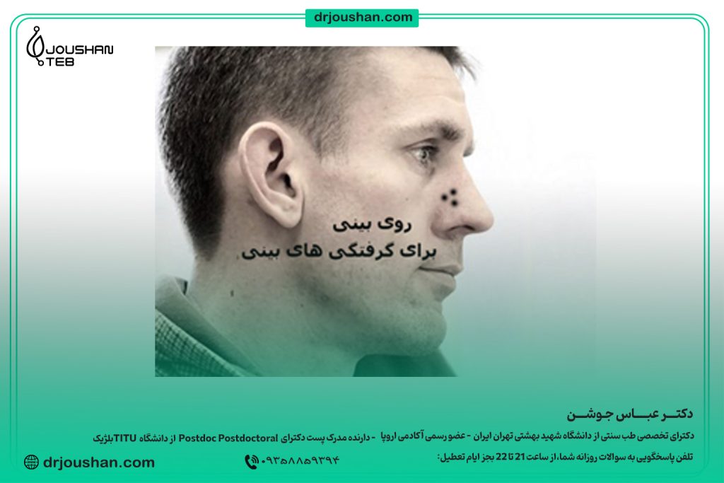زالو گذاری روی بینی