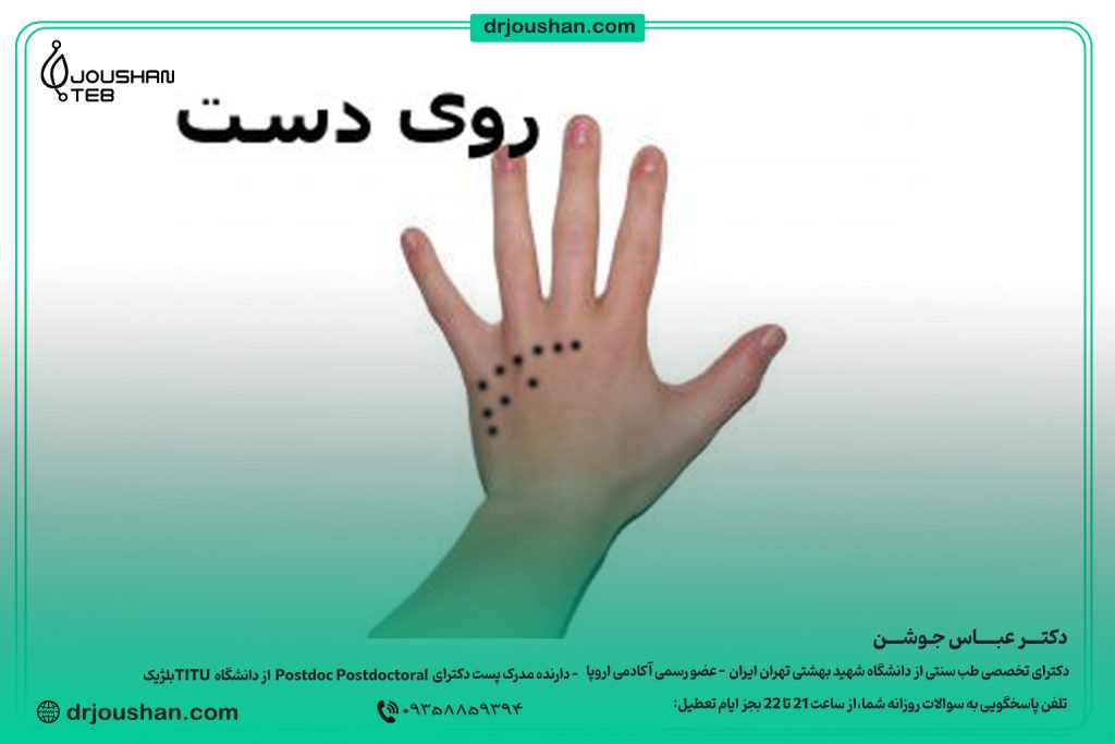زالو گذاری روی دست