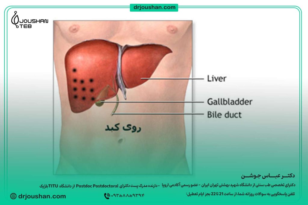 زالو گذاری روی کبد