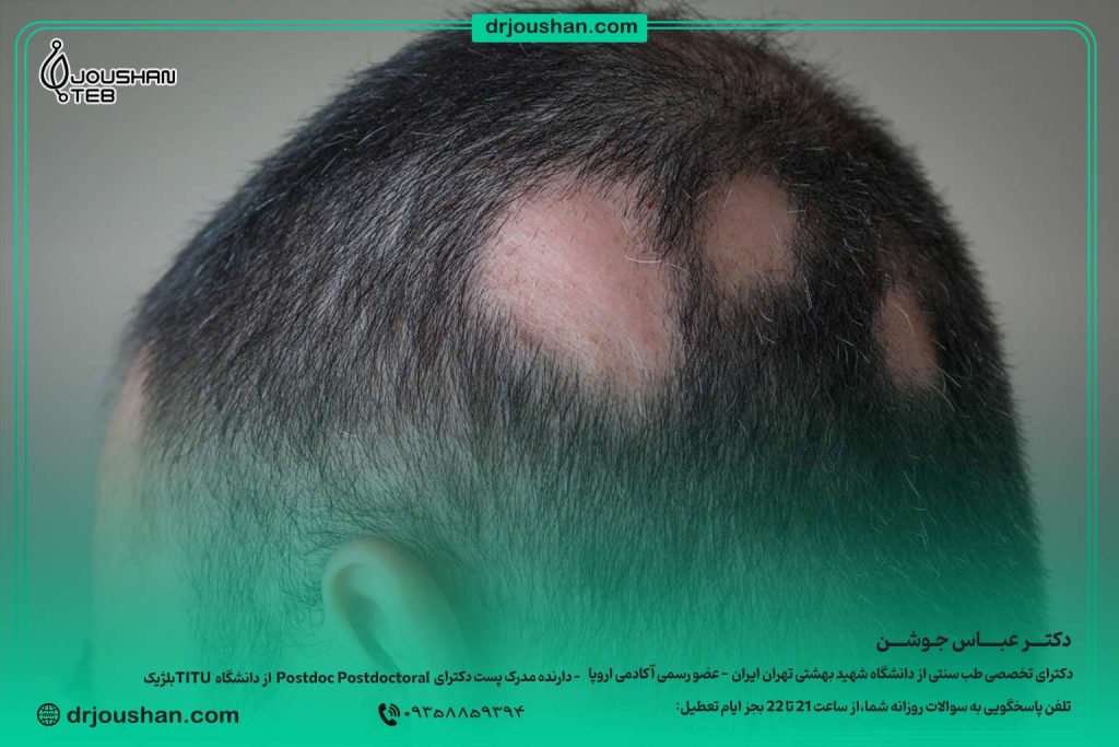 درمان ریزش-موی-سکه‌ای