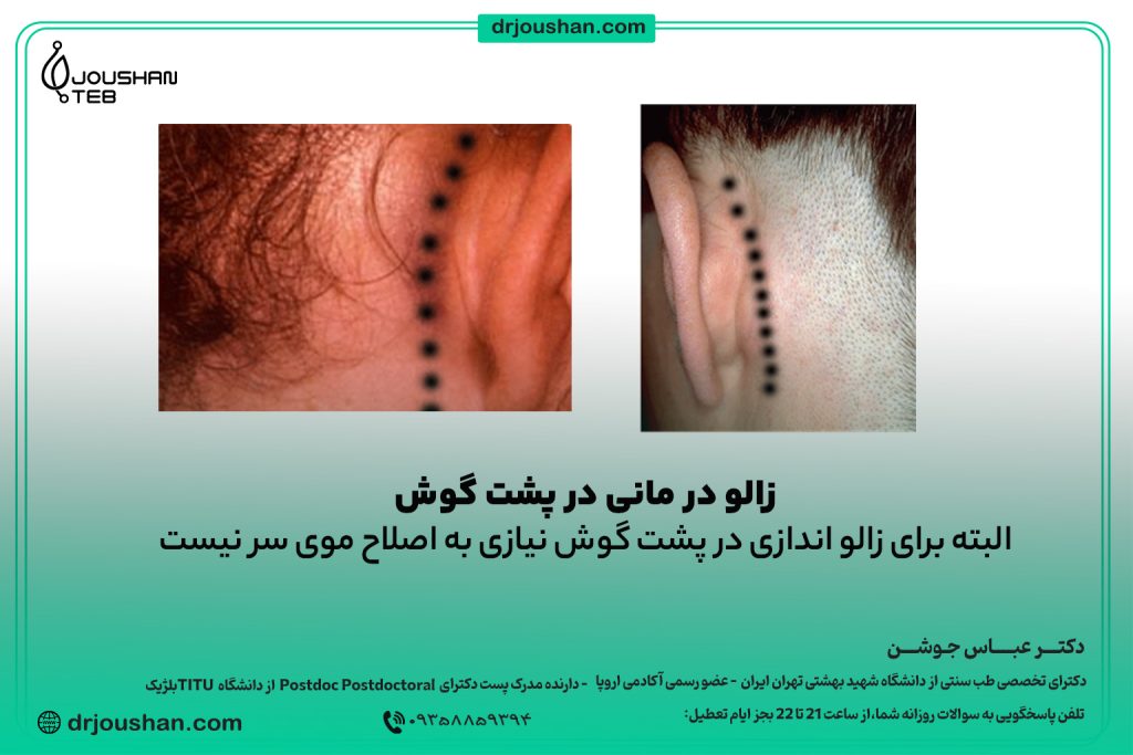 زالو-درمانی-در-پشت-گوش