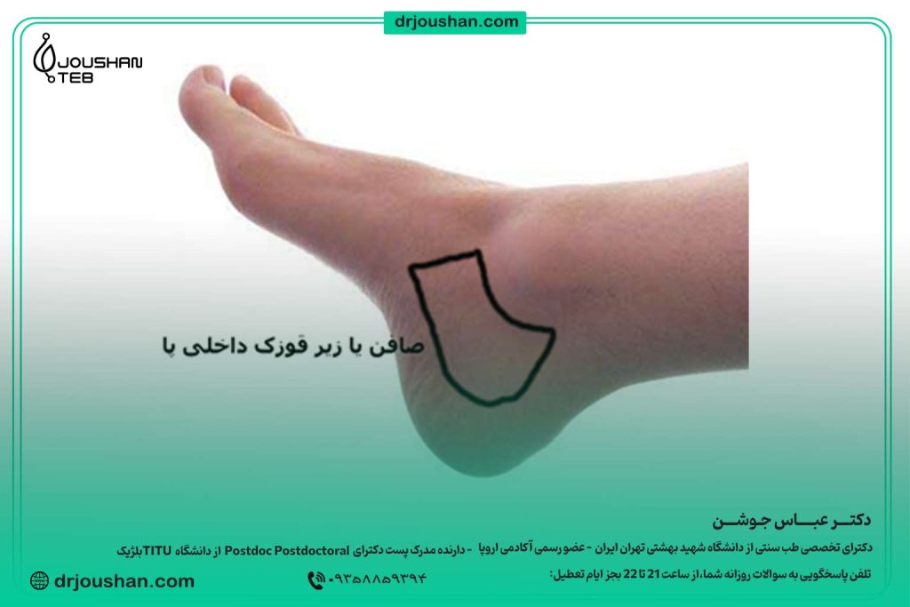 زالو گذاری در زیرقوزک-داخلی-پا