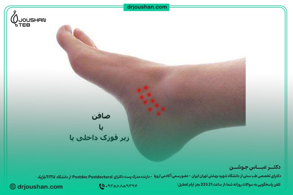 زالو گذاری در زیرقوزک-داخلی-پا