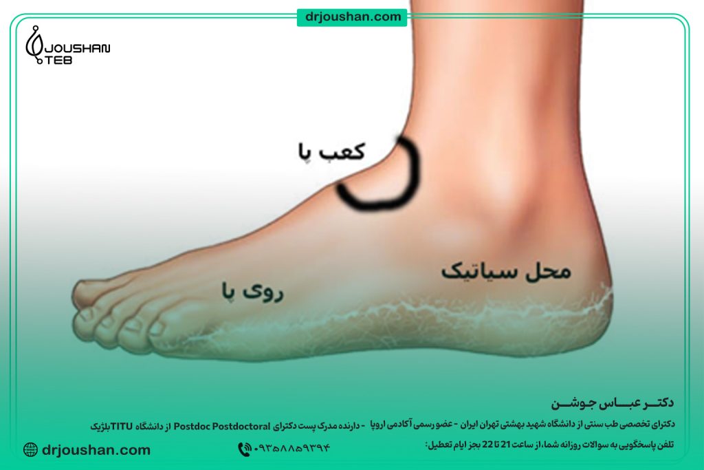 زالو گذاری در محل سیاتیک