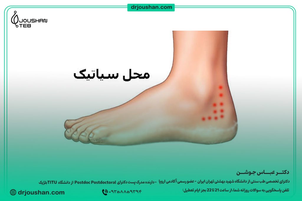 زالو گذاری در محل سیاتیک