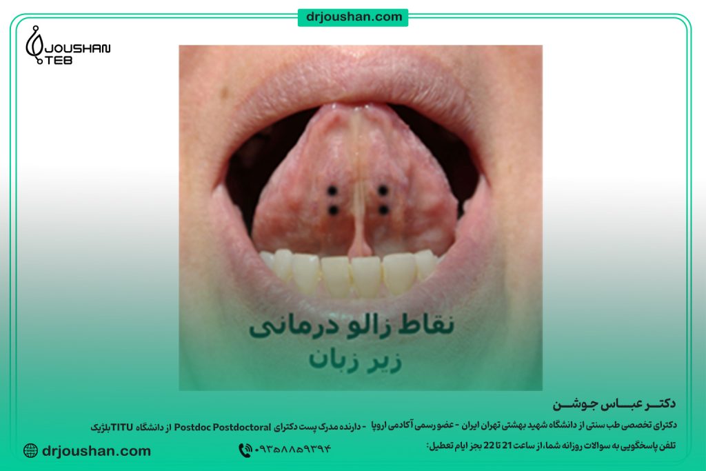زالو گذاری-زیرزبان