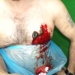 گرفتگی عروق قلبی با زالو درمانی - دکتر عباس جوشن