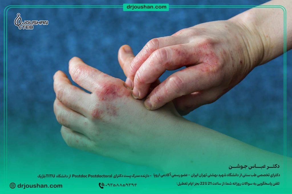 با-اگزما-و-قرمزی-دست-چه-کنیم؟-دکتر-عباس-جوشن