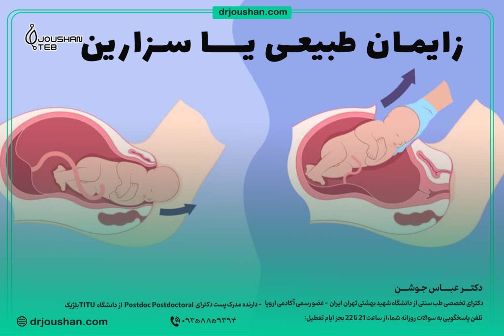 زایمان-طبیعی-یا-سزارین-دکتر-عباس-جوشن