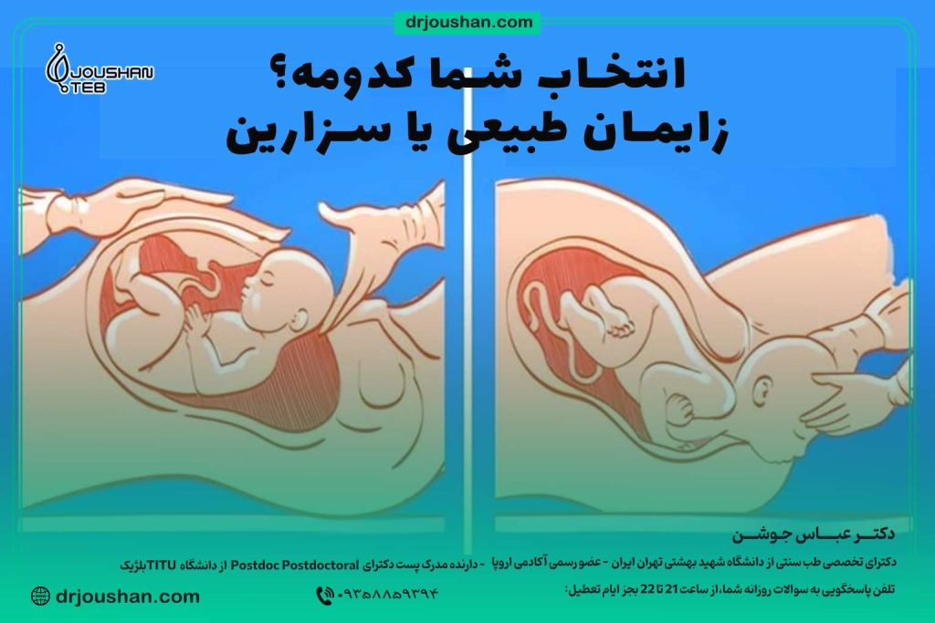 زایمان-طبیعی-یا-سزارین؟؟-دکتر-عباس-جوشن