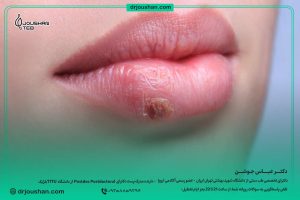 برای-تبخال-لب-چکار-کنیم؟-دکتر-عباس-جوشن