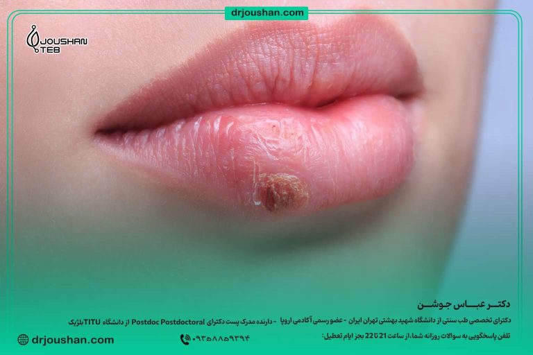 برای-تبخال-لب-چکار-کنیم؟-دکتر-عباس-جوشن