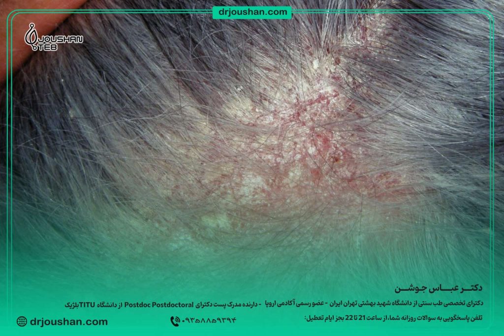 برای-درماتیت-سبوره-چی-بخوریم؟-دکتر-عباس-جوشن
