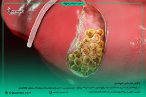 برای-درمان-سنگ-صفرا-چی-بخوریم؟-دکتر-عباس-جوشن