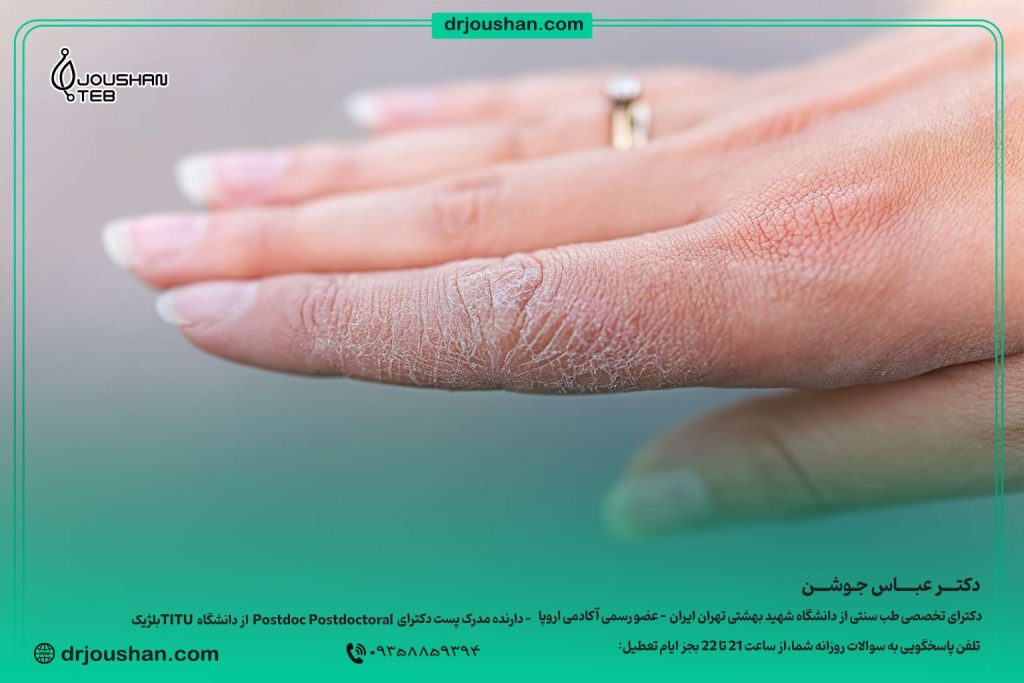 خشکی-دست-و-صورت--دکتر-عباس-جوشن