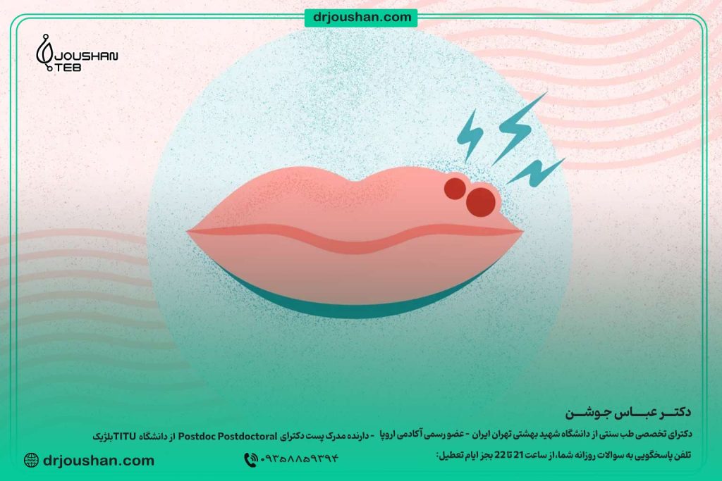 درمان-تبخال-لب-در-طب-سنتی-دکتر-عباس-جوشن