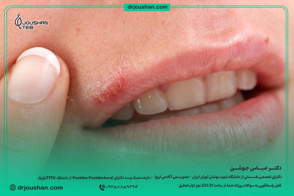 درمان-تبخال-لب-دکتر-عباس-جوشن