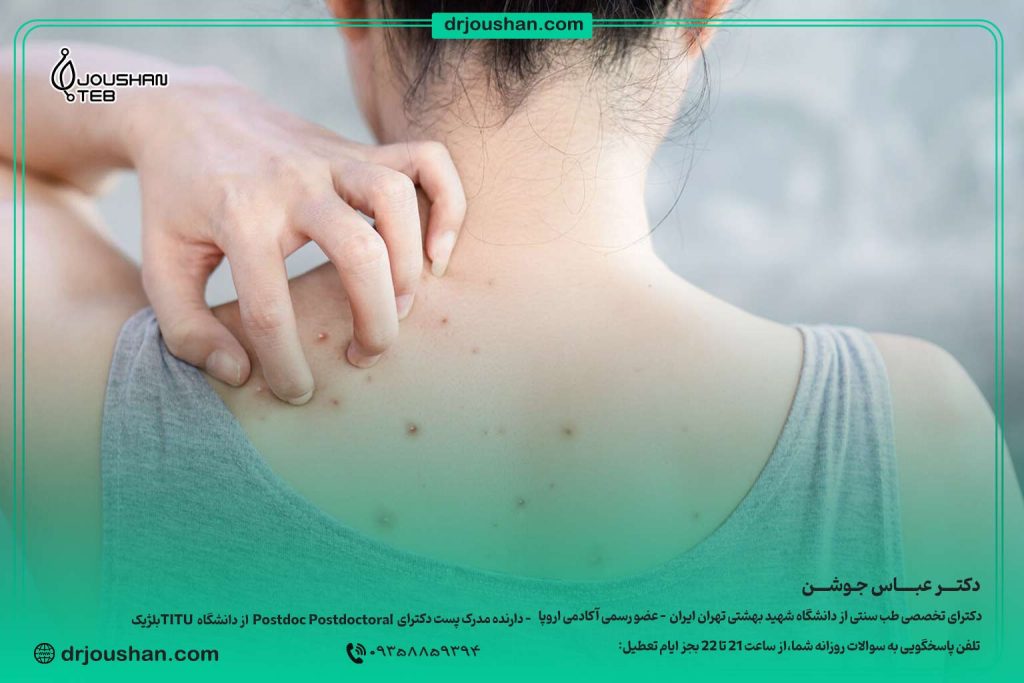 درمان-جوش-و-اکنه-بدن-دکتر-عباس-جوشن