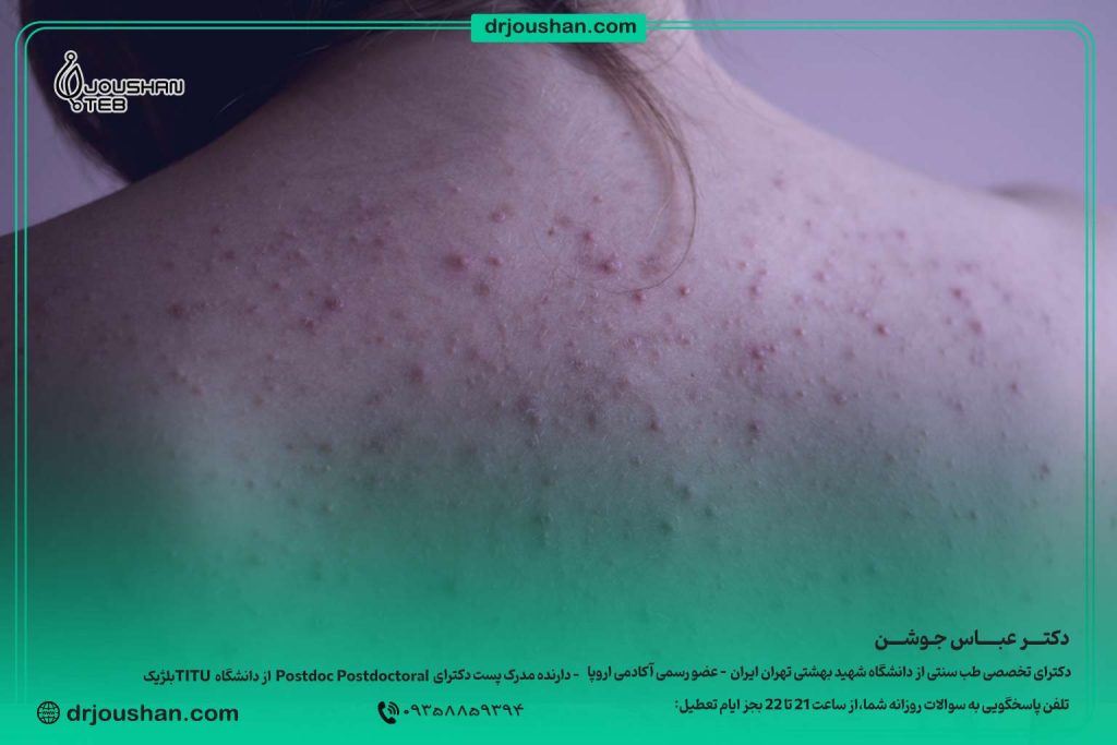 درمان-جوش-و-اکنه-در-بدن-ورزشکاران-دکتر-عباس-جوشن