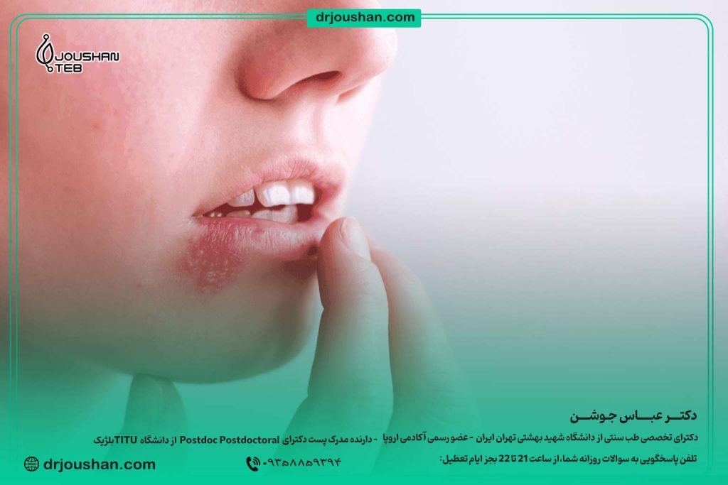 درمان-خانگی-تبخال-لب-در-طب-سنتی-دکتر-عباس-جوشن