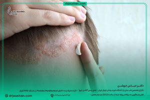 درمان-خانگی-درماتیت-سبوره--دکتر-عباس-جوشن
