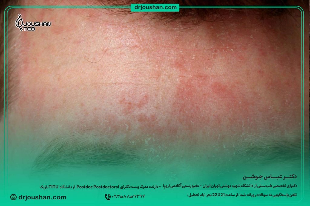درمان-درماتیت-سبوره-دکتر-عباس-جوشن