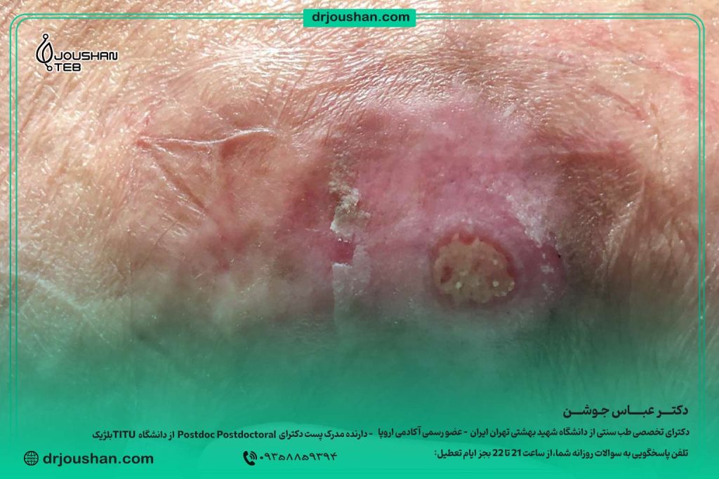 درمان-زخم-بستر-و-پیشگیری-از-ایجاد-آن-دکتر-عباس-جوشن
