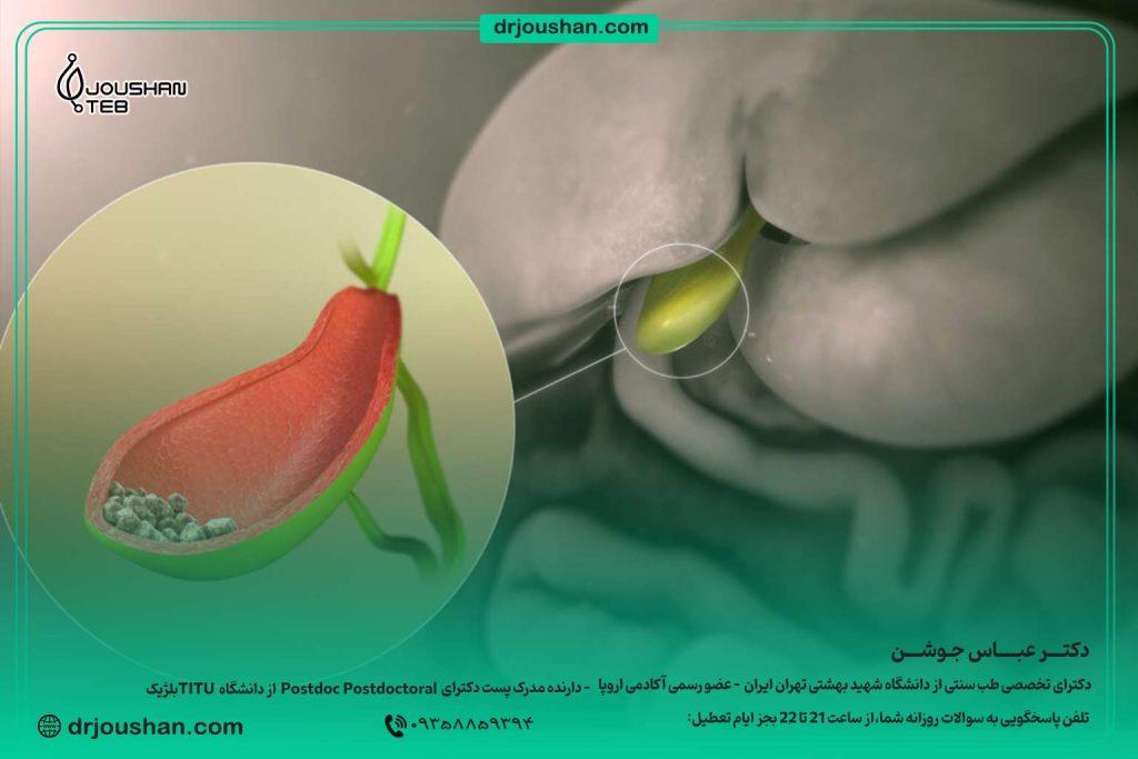 درمان-سنگ-صفرا-دکتر-عباس-جوشن