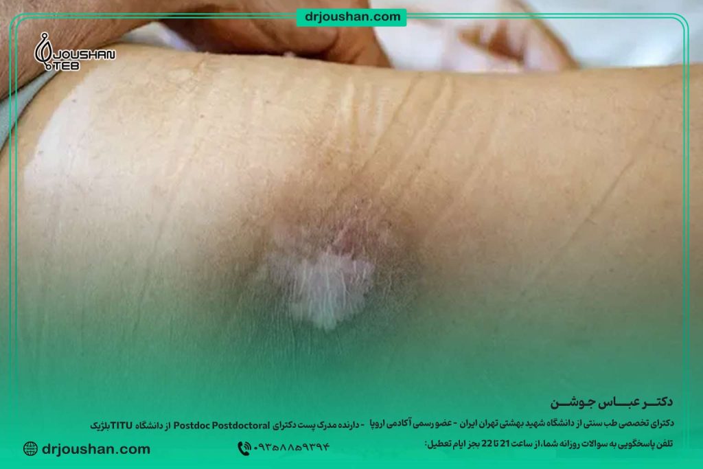 درمان-و-پیشگیری-از-زخم-بستر-دکتر-عباس-جوشن