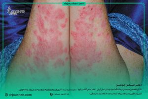 درمان-پسوریازیس-دکتر-عباس-جوشن