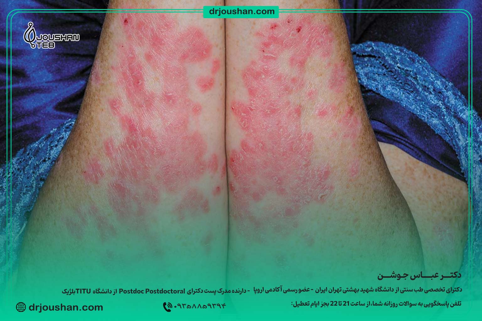 درمان-پسوریازیس-دکتر-عباس-جوشن