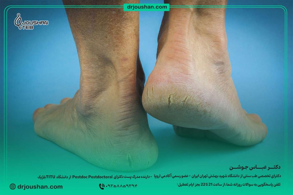 راه-حل-درمان-ترک-پاشنه-پا-دکتر-عباس-جوشن