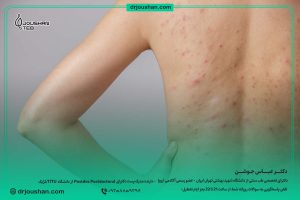 راه-حل-درمان-جوش-و-اکنه-در-بدن-ورزشکاران-دکتر-عباس-جوشن
