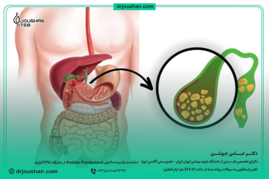 رژیم-غذایی-دفع-کننده-سنگ-صفرا-دکتر-عباس-جوشن
