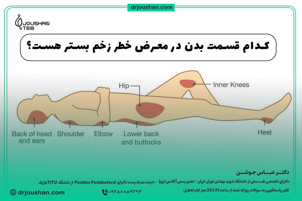 در کدام قسمت بدن زخم-بستر تشکیل میشود