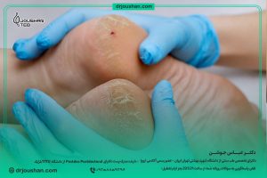 علت-ایجاد-ترک-پاشنه-دکتر-عباس-جوشن