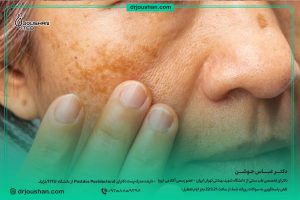 علت-ایجاد-لکه-صورت-دکتر-عباس-جوشن