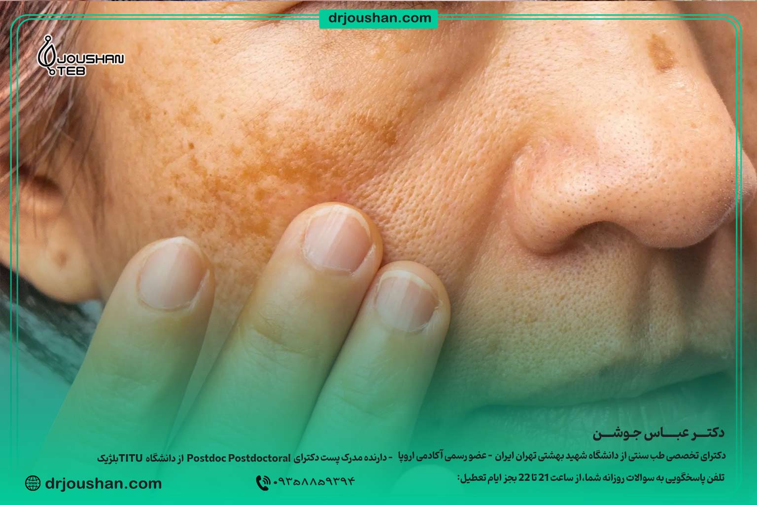 علت-ایجاد-لکه-صورت-دکتر-عباس-جوشن