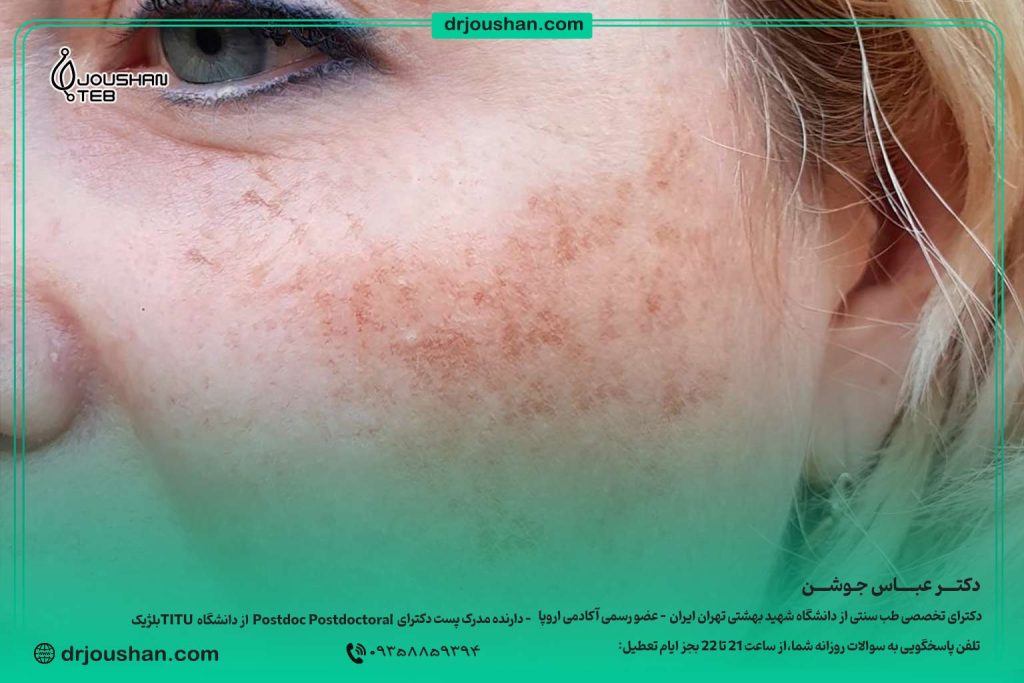 علت-لکه-قهوه-ای-صورت-دکترعباس-جوشن