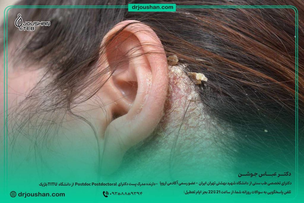 علت-و-درمان-درماتیت-سبوره-دکتر-عباس-جوشن