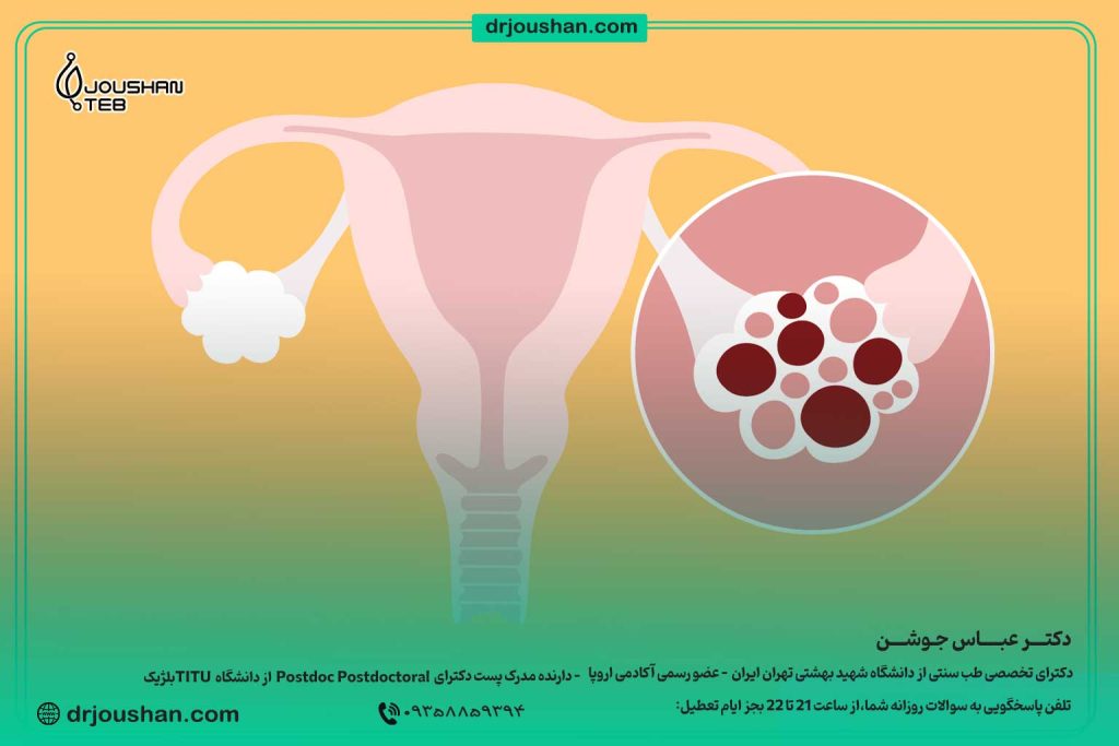 -درمان-سندرم-تخمدان-پلی‌کیستیک--و-سردی-رحم(PCOS)دکتر-عباس-جوشن--